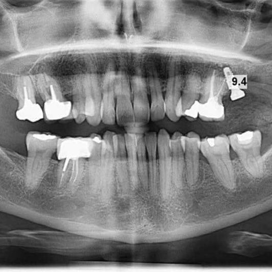 Formation - Échecs et complications en implantologie - e-learning