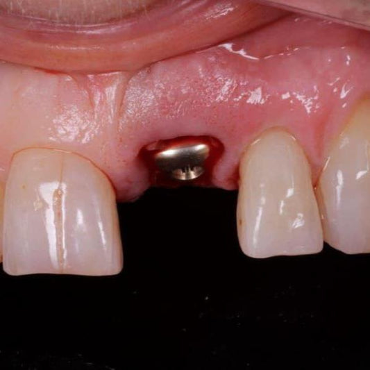 Formazione - Gestione del profilo di emergenza in implantologia