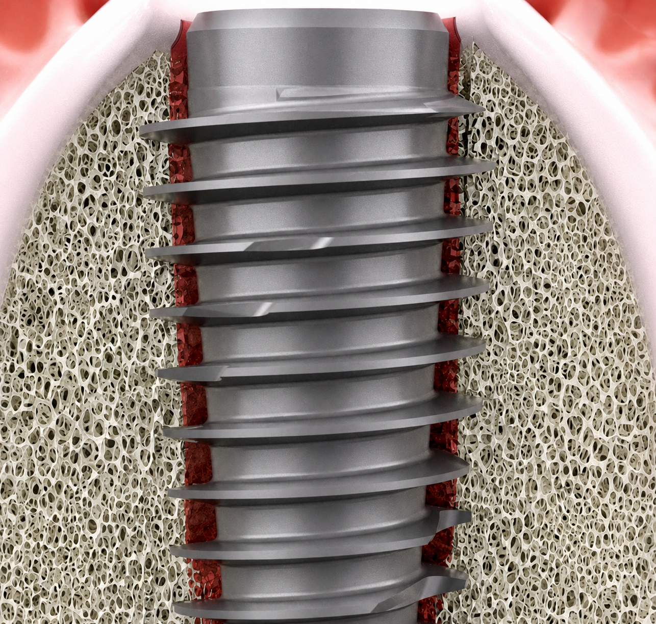 Implant dentaire iBone® G - Livré avec une vis de cicatrisation