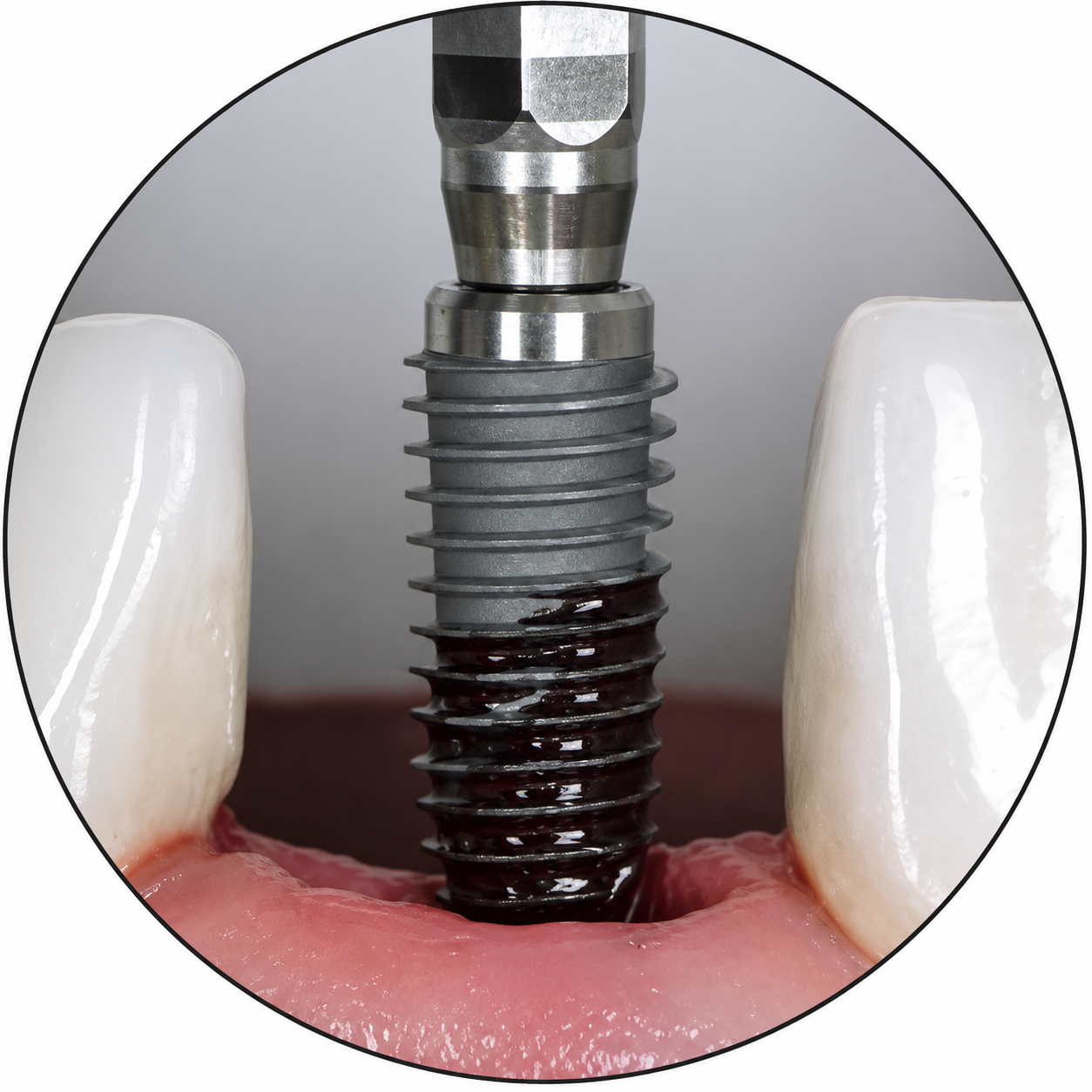 Implant dentaire iBone® G - Livré avec une vis de cicatrisation