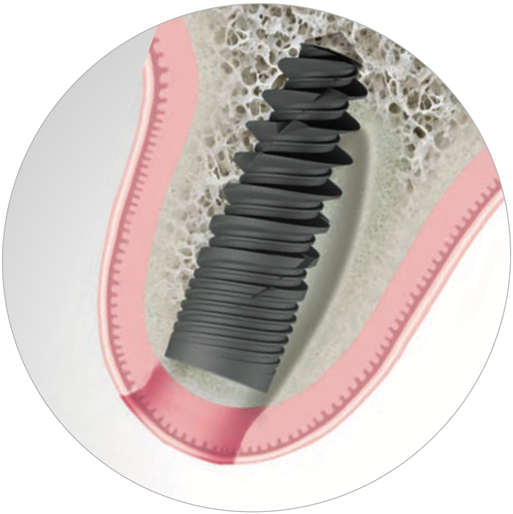 Implant dentaire Naturactis Ø3 - Livré avec une vis de couverture