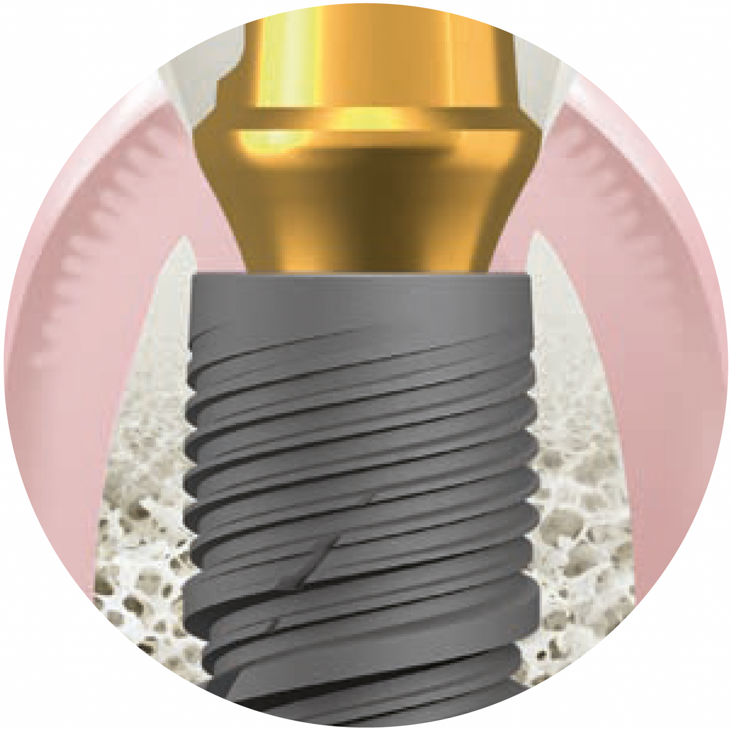 Implant dentaire Naturactis Ø3 - Livré avec une vis de couverture