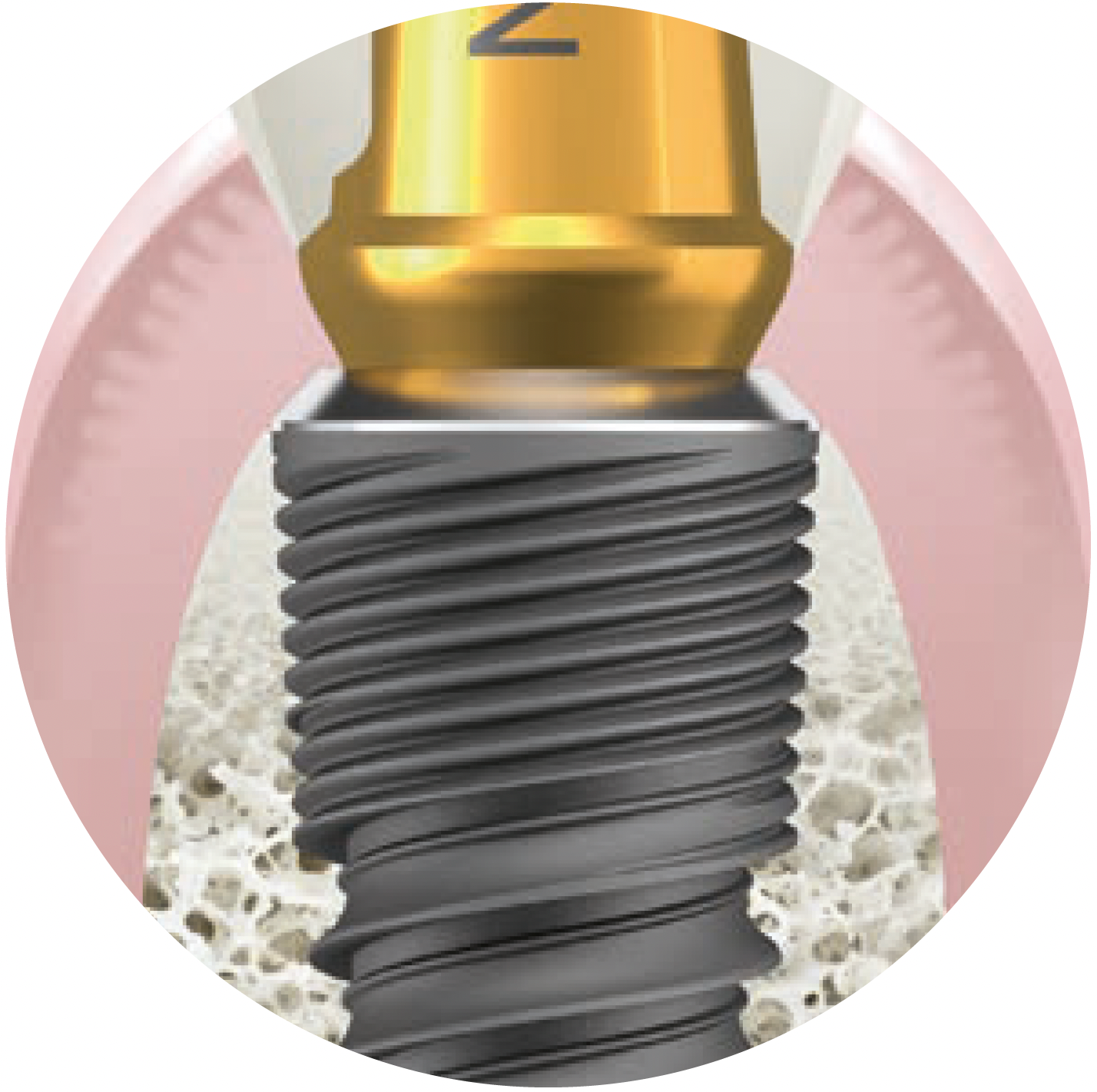Implant dentaire Naturall+ Ø3 - Livré avec une vis de couverture