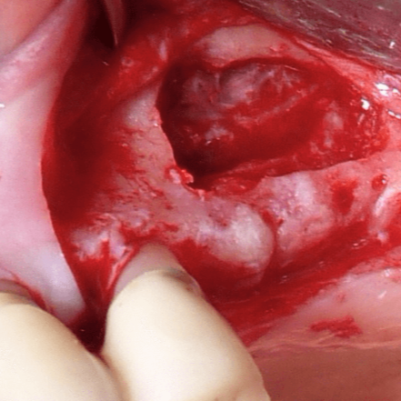 Formation - Aménagement du sinus maxillaire