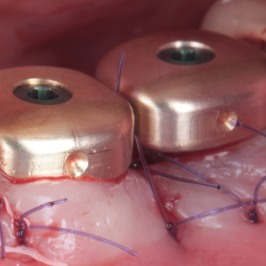 Formazione - Sistemazione del seno mascellare